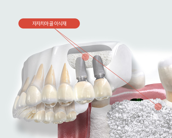 자가치아 골이식재 임플란트 일러스트